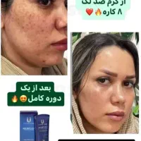 لک جای جوش جای زخم فقط با یه کرم