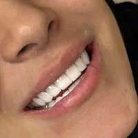 کامپوزیت دندان اقساطی بدون بهره