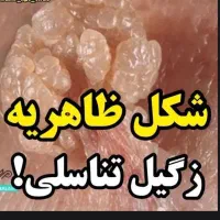 درمان زگیل وHPV