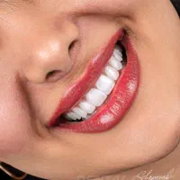دندانپزشکی شرایط اقساط/لمینیت/کامپوزیت