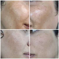 مزوتراپی ، PRP و مزونیدلینگ