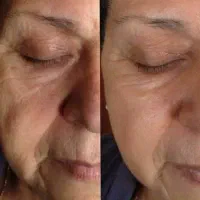 کرم جوانساز بیومتیک جایگزین بوتاکس