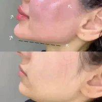 ژل و بوتاکس فقط ۳۹۰|خدمات آرایشگری و زیبایی|قم, زنبیل آباد|دیوار