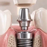 ایمپلنت ،لمینیت ، کامپوزیت اقساطی