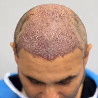 کاشت مو و ابرو|خدمات آرایشگری و زیبایی|رشت, بوسار|دیوار