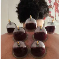 حجامت پاییزه طب سوزنی امبدینگ فصد خون زالو درمانی