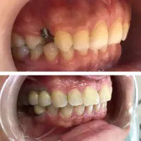 دندانپزشکی/ترمیم/کامپوزیت/لمینیت/عصبکشی قسطی|خدمات آرایشگری و زیبایی|مشهد, سجاد شهر|دیوار