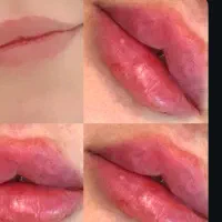 خدمات فیلر و بوتاکس