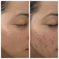 فیشیال تخصصی پوست،با تخفیف ویژه