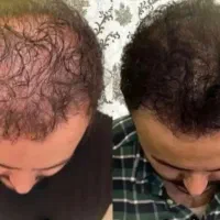 معجزه رویش موهات