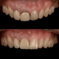 ایمپلنت دیجیتال با روکش تمام سرامیک ۱۴.۵۰۰