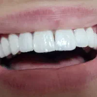 دهان و دندان(زیبایی ،لمینیت