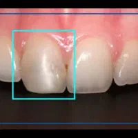 عصبکشی اندو دندان جلو۱۲۳تعرفه دولتی|خدمات آرایشگری و زیبایی|قم, زنبیل آباد|دیوار
