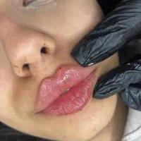 ژل فیلربوتاکس پی ار پی نیدلینگ سابسیژن چال گونه