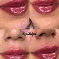 ژل و بوتاکس مزو و انزیم، سیار هستم...|خدمات آرایشگری و زیبایی|قرچک, شهرک طلائیه|دیوار