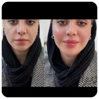 تزریق تخصصی فیلر، بوتاکس، ژل ، مطب زیبایی|خدمات آرایشگری و زیبایی|شیراز, سینما سعدی|دیوار