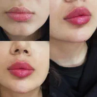 تزریق ژل و آنزیم غبغب وبینی وتزریق آنزیم تخلیه ژل|خدمات آرایشگری و زیبایی|اردبیل, |دیوار