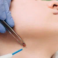 زگیل تناسلیhpv/میخچه/زیگیل/خال/اسکین بواسیر hsv|خدمات آرایشگری و زیبایی|تهران, علم و صنعت|دیوار