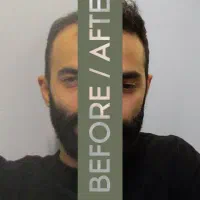 کاشت مو و ابرو|خدمات آرایشگری و زیبایی|تهران, جردن|دیوار