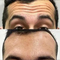 بوتاکس
