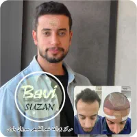 مرکز کاشت موی سر و ابرو و ریش با ضمانت نامه کتبی