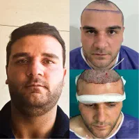 کاشت مو/کاشت ریش/کاشت ابرو اقساط*ی در اصفهان|خدمات آرایشگری و زیبایی|فولادشهر, فولادشهر|دیوار