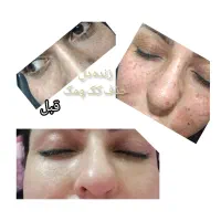 پلکسر پلاسما خالبرداری مزونیدلینگ مزو آموزش|خدمات آرایشگری و زیبایی|زاهدان, |دیوار