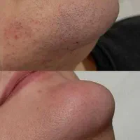 لیزر موهای زائد لیزرفول لیزر آقایان  لیزر بانوان|خدمات آرایشگری و زیبایی|اصفهان, باغ زرشک|دیوار