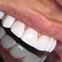 دندانپزشکی بامناسب‌ترین قیمت ایمپلنت درمانی زیبایی|خدمات آرایشگری و زیبایی|تهران, فلسطین (میدان انقلاب)|دیوار
