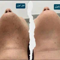 لیزر موج کندلا لیزر بانوان  لیزر آقایان لیزر خانم|خدمات آرایشگری و زیبایی|اصفهان, باغ زرشک|دیوار