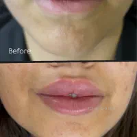 ژل/بوتاکس/مزو ژل/وآموزش|خدمات آرایشگری و زیبایی|خرمشهر, |دیوار