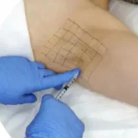 ۵۰ درصد تخفیف بوتاکس