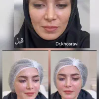 آف ویژه تزریق ژل و بوتاکس