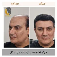 ترمیم مو /پروتز مو  / جایگزین کاشت مو و کلاهگیس|خدمات آرایشگری و زیبایی|اصفهان, آبشار|دیوار