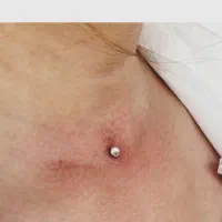 پاکسازی تخصصی اصلاح ابرو صورت موخوره گیری