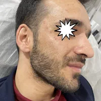 ژل وبوتاکس بلک فرایدی404(اقساط)(توسط پزشک)|خدمات آرایشگری و زیبایی|خرمآباد, |دیوار