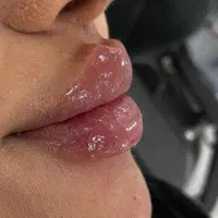 تزریق ژل بوتاکس مزونیدلینگ ، مزوسروابرو ،فیلربادی|خدمات آرایشگری و زیبایی|تهران, نیروی هوایی (پیروزی)|دیوار