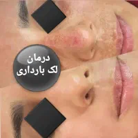 پاکسازی و جوانسازی پوست . هایفو صورت و غبغب|خدمات آرایشگری و زیبایی|مشهد, سجاد شهر|دیوار