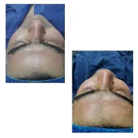 آموزش فیشال و پاکسازی پوست ویژه سال جدید|خدمات آموزشی|خوی, |دیوار