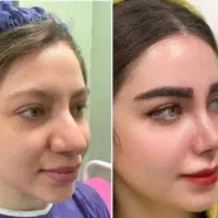 جشنواره کاشت ابرو نانوگرفت سوپرنچرال و رینوپلاستی