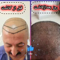 کاشت مو در شیراز