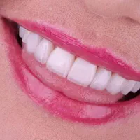 کلینیک الماس دندانپزشکی،روکش عصب کشی