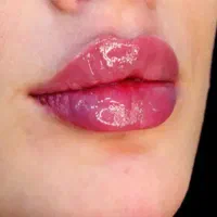 ژل، بوتاکس،لیزر،پی ارپی