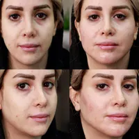 تزریق ژللب ،گونه،زاویه فک و چانه و بوتاکس،مادلینگ|خدمات آرایشگری و زیبایی|اصفهان, رکن الدوله شرقی|دیوار