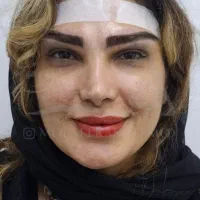 آف کاشت ابرو و مو ۵۰٪در درمانگاه کمیل