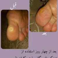 ترک پا،میخچه، اگزما