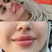 تزریق ژل بوتاکس نخ ...توسط پزشک در کلینیک سایماه|خدمات آرایشگری و زیبایی|کرمان, |دیوار