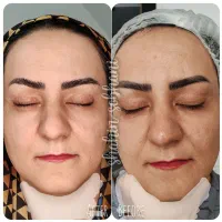 رفع لک ها و روشن سازی پوست|خدمات آرایشگری و زیبایی|اصفهان, مفتح|دیوار