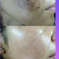 درمان لک درخانه|آرایشی، بهداشتی، درمانی|زرند, |دیوار