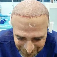 کاشت مو تخصصی دلربا|خدمات آرایشگری و زیبایی|حمیدیه, |دیوار